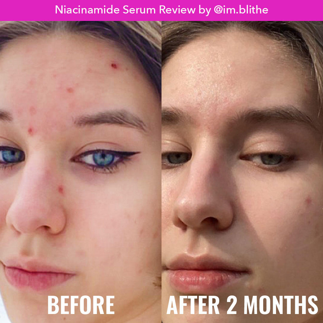 Niacinamide Serum